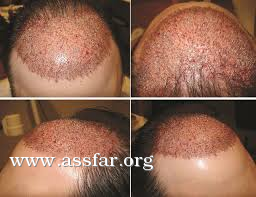 800 سعودي سافروا لتركيا لزراعة الشعر